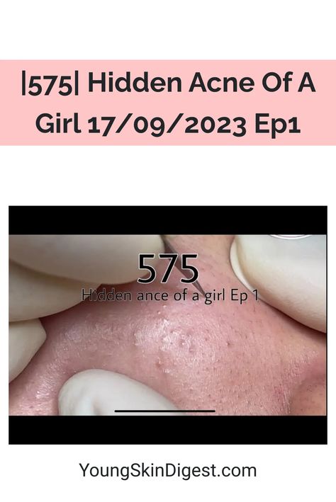 |575| Hidden Acne Of A Girl 17/09/2023 Ep1 Acne Recipes, Bad Acne, Radiant Skin, Diy Food Recipes, A Girl, The Future, Acne