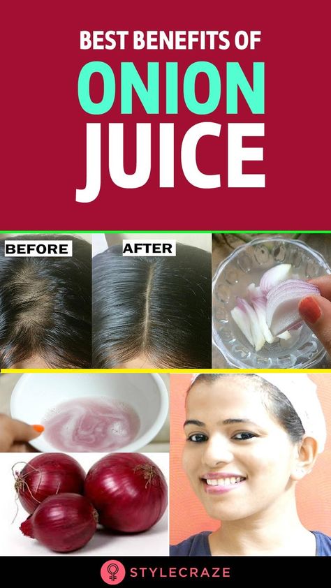 Onion Juice For Hair, Juice For Skin, Stop Hair Loss, Onion For Hair, Remedy For White Hair, Onion Benefits, Hair Growth Treatment, How To Grow Natural Hair, Why Hair Loss