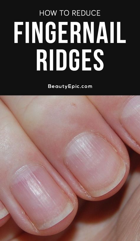 Find Out Whether Those Ridges On Your Fingernails Are Harmful Or Not Nail Fungus Remedy, Brittle Nails, Fingernail Health Signs, Natural Nail Fungus, Fingernail Ridges, Fingernail Health, Nail Fungus, Different Types Of Nails, Types Of Nails