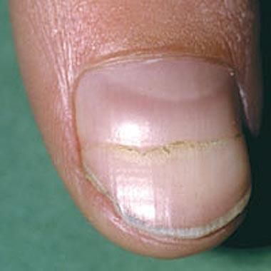 Beau's lines, transverse ridge, nails, fingernails