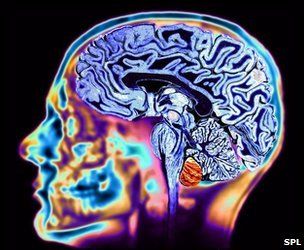 MRI scan of a brain - beautiful Wisconsin, Fitness, Influenza, Neurology, Rita, Mri Brain, Medical, Neuroscience, Mri