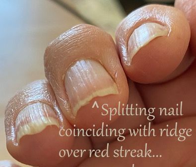 Splitting Nails · Health Boundaries Ridges On Nails, How To Fix A Split Fingernail, Splitting Fingernails, Split Nail Repair, Fingernail Ridges, Fingernail Health Signs, Nail Growth Faster, Fingernail Health, Nail Remedies