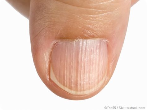 What is Longitudinal Ridging? | News-Medical Home Remedies, Health, Fingernail Health, Toe Nails, Remedies, Fingernails, Kropp, Fingernail Ridges, Aging