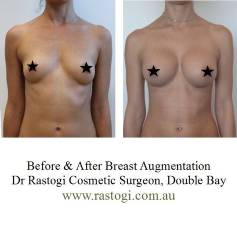 Glow, Yoga Fitness, Inspiration, Breast Augmentation Size, Breast Augmentation, Breast Implants Sizes, Implants Breast, Breast Lift Surgery, Breast Reconstruction