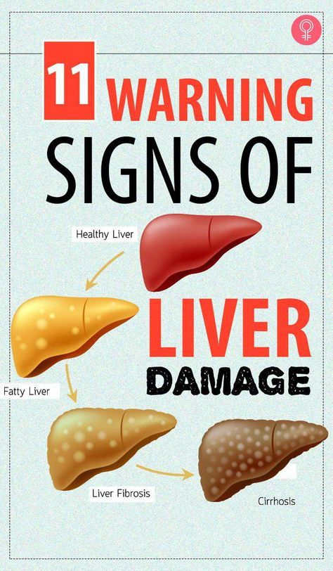 10 Warning Signs Of Liver Damage: whenever there is something wrong with the liver, it displays certain symptoms or warning signs that indicate that it isn’t working properly. Some people experience a sudden weight gain, and even though they try their best, they are unable to lose weight #liverdamage #health #wellness #healthcare #BestFoodsToEatOnADiet Detox, Nutrition, Fitness, Liver Failure Symptoms, Liver Disease Symptoms, Liver Issues, Liver Failure, Liver Disease, Signs Of Liver Problems