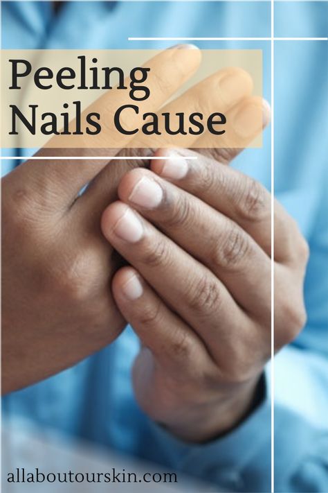 If you have a career as a hairstylist or cleaner, you may be very familiar with this situation. Constantly having your hands in water can cause brittle, split or peeling nails. Repetitive wetting and drying of hands are the most common reason for peeling nails. Dry Cuticles, Brittle Fingernails, Peeling Fingernails, Peeling Nails, Brittle, Split Nail Repair, Brittle Nails, Nail Treatment Diy, Damaged Nails