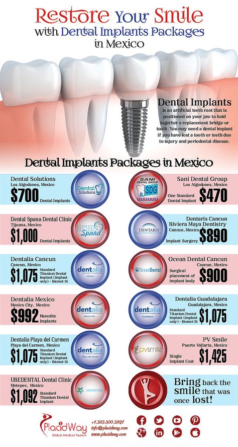 Dental Health, Dental Implants Cost, Affordable Dental Implants, Dental Implant Procedure, Dental Treatment, Dental Procedures, Best Dental Implants, Affordable Dental, Dental Hygenist