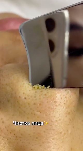 blackheads satisfying video Satisfying Video, Pimples, Squeezing Zits, Best Weight Loss Foods, Oddly Satisfying Videos, Zit Popping Videos, Zit Popping Video Faces, Face Care Tips, Diy Skin Care Routine