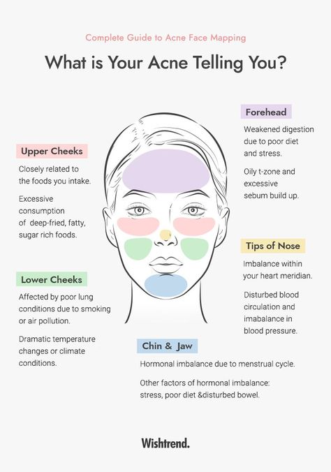 Causes Of Acne, What Causes Chin Acne, How To Treat Acne, Acne Location Meaning, How To Cure Acne, Prevent Acne, Treating Acne, Acne Causes