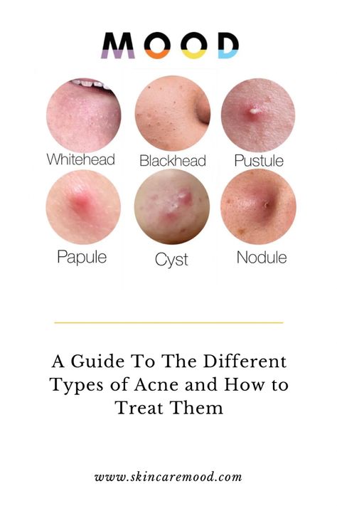 Fitness, Treatment Of Acne, Acne Location Meaning, Natural Remedies For Acne, Severe Acne Treatment, Chin Acne Remedies, Chin Acne Causes, Cystic Acne Treatment, Remedy For Acne