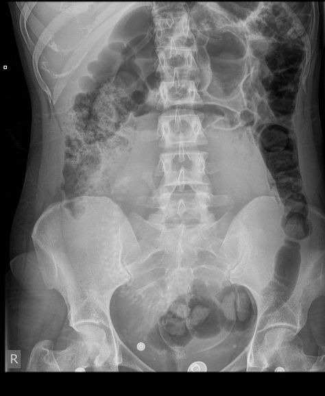 Fetus: on abdominal radiograph Xray Humor, Radiology, Pathology, Radiology Technician, Radiation, Xray Tech, Radiology Student, Radiology Technologist, Ultrasound