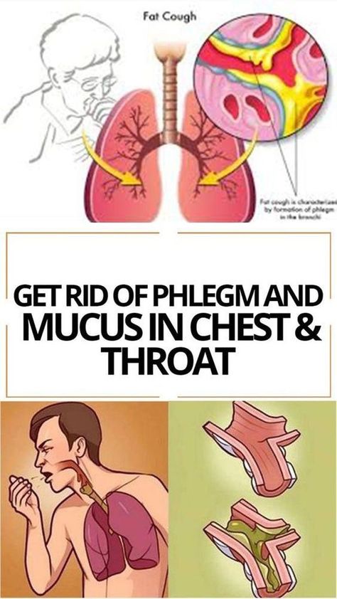 Mucus accumulations make you feel as if there’s something stuck in your throat. You sense an urge to clear your throat, and it’s really frustrating. This problem is usually created by infections in the upper respiratory tract, but mucus accumulations may be triggered by allergies, asthma, and he... Mucus In Chest, Mucus In Throat, Getting Rid Of Mucus, Chest Congestion Remedies, Mucus Relief, Sinus Drainage, Congestion Remedies, Home Remedies For Bronchitis, Getting Rid Of Phlegm