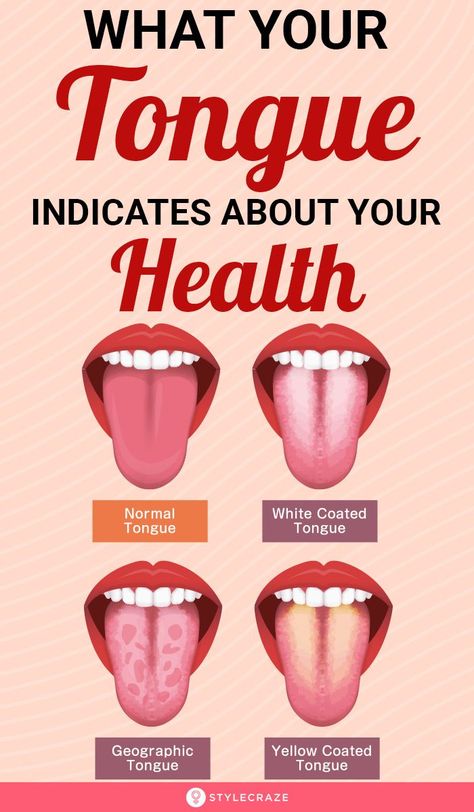 Karma, Nutrition, Tongue Problems, Tongue Health, Tongue Infection, Tongue Ulcer Remedies, Tongue Ulcer, Bumps On Tongue, White Tongue Causes