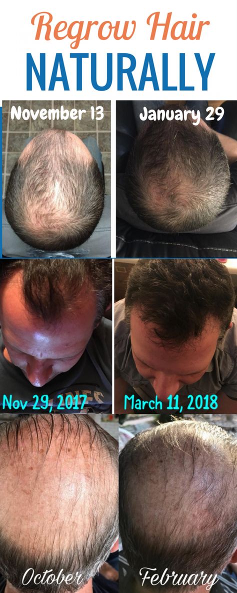 Regrow Hair Products - 7 Real Men Tell All With Before & After Pictures Prevent Hair Loss, Regrow Hair Naturally, Promotes Hair Growth, Oil For Hair Loss, Natural Hair Loss Treatment, Hair Loss Remedies, Reduce Hair Growth, Regrow Hair, Hair Growth Secrets