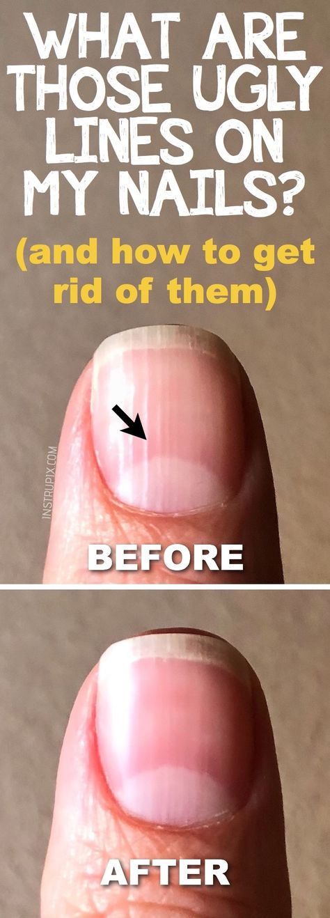 What are those vertical lines on your nails, and what it means about your health? Instrupix.com Natural Remedies, Nail Art Designs, Ridges In Nails, Ridges On Nails, Vertical Nail Ridges, Nail Health, Nail Ridges, Tongue Health, Natural Health