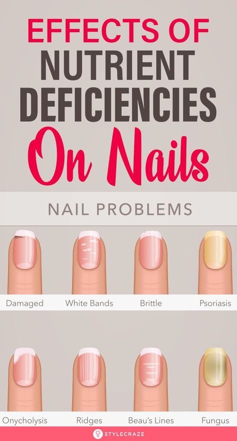 Effects Of Nutrient Deficiencies On Nails: Their shape, texture, color, growth rate �– everything is a sign that your body is screaming for nutrients. Most of the changes in your nails and skin occur due to vitamin and nutrient deficiency. Here’s a list of symptoms that you may notice in your nails and what they mean for your health. #Nails #NailCare #NutritionDeficiency #NailCareTips Design, Nail Diseases And Disorders, Nail Health Problems, Nail Health Signs, Fingernail Health Signs, Nail Symptoms, Nail Psoriasis, Nail Disorders, Nail Health