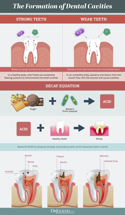9 Steps to Prevent Cavities Naturally - DrJockers.com Dental Health, Causes Of Tooth Decay, Dental Cavities, How To Prevent Cavities, Oral Health, Oral Health Care, Remedies For Tooth Ache, Nutritional Deficiencies, Cure Tooth Decay