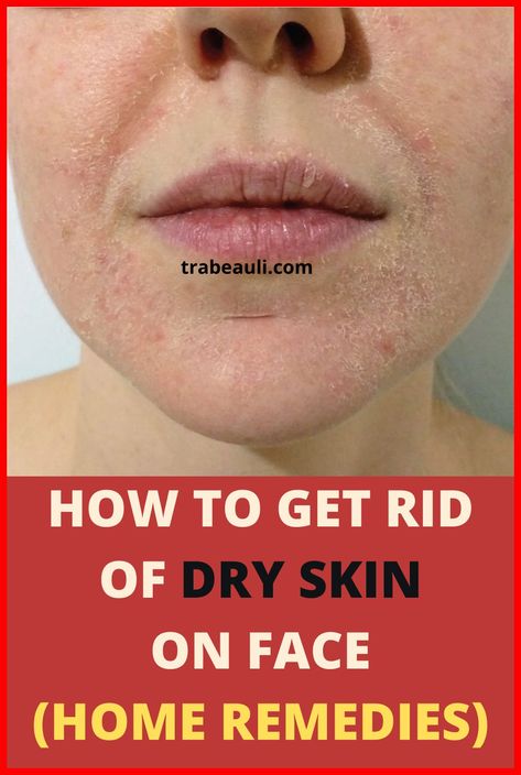 Natural Hacks For Your Skin Problems Fitness, Remedies For Dry Skin, Treating Dry Skin, Dry Itchy Skin, Dry Skin Problem, Severe Dry Skin, Healing Dry Skin Naturally, Help Dry Skin, Extremely Dry Skin