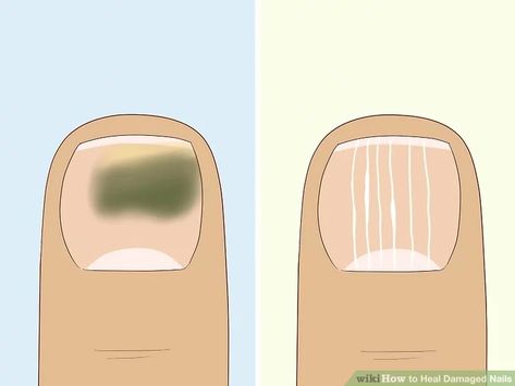 3 Ways to Heal Damaged Nails - wikiHow Ideas, Damaged Nails Repair, Nail Damage Remedies, How To Grow Nails, Damaged Nails, Broken Toe, Damaged, Split Nail Repair, How To Cut Nails