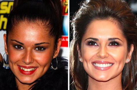 33 Before And After Photos That Prove Good Teeth Can Change Your Entire Face Celebrities, Cheryl Cole, Celebrities With Braces, Celebrity Teeth, Celebrity Smiles, Whitening, Celebs, White Teeth, White Smile
