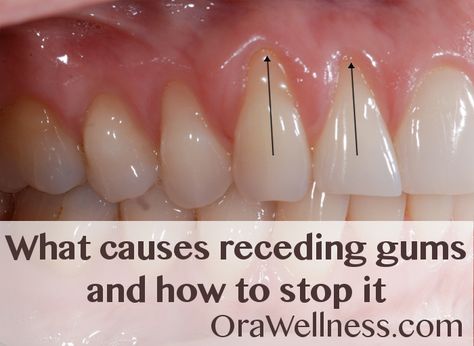 Holistic answers to the questions about receding gums. Fitness, Reverse Receding Gums, Receding Gums, Swollen Gum, Grow Back Receding Gums, Teeth Health, Oral Health, Gum Recession Treatment, Receeding Gums