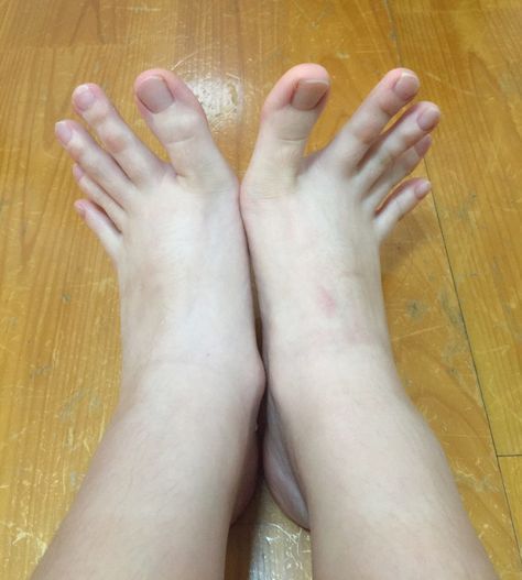 Aaaahhhhh!!! I cannot deal with these toes! Gross Feet, Weird, Feet, Toe Pics, Orthodontia, Foot Pics, Foot Pictures, Being Ugly, Ingrown Toe Nail