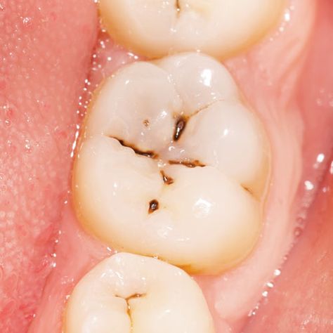 Idyll Dental:   You Might Be More Prone to Cavities You brush an... Detox, Natural Remedies, Heal Cavities, Cavity Pain, Reverse Cavities, Remedies, Tooth Decay, Health Remedies, Natural Medicine