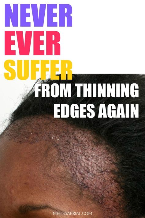 Queen, Diy, Thinning Edges, Edge Growth Treatment For Black Women, Stimulate Hair Growth, Thinning Hair, Hair Loss Women, Hair Breakage, Thinning Hair Women