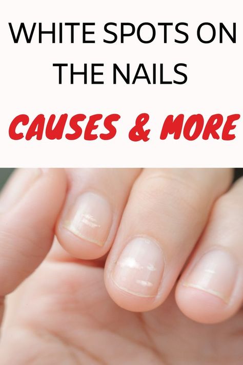 Looking beautiful and well-groomed nails is an indicator of being healthy as well as being physically. However, from time to time, white spots may occur on the nails that overshadow this beauty. So what is the reason for this, what causes a white spot on the nails, how does it pass? Here are the causes of white spots on nails and the necessary tips to get rid of them… Fitness, White Spots In Nails, White Spots On Toenails, White Spots Under Nails, White Spots On Fingernails, White Spots On Nails, Nail Health Signs, Nail Health, Pitted Nails