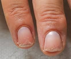 Fixing damaged nails Fix Broken Nail, Damaged Nails Repair, Brittle Nails, Damaged Nails, How To Strengthen Nails, Cracked Nails, Strengthen Nails Naturally, Nail Bed Damage, Nail Repair