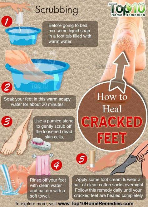 Fitness, Cracked Heel Remedies, Dry Cracked Feet, Cracked Feet, Foot Remedies, Feet Treatment, Foot Soak, Diy Foot Scrub, Feet Care