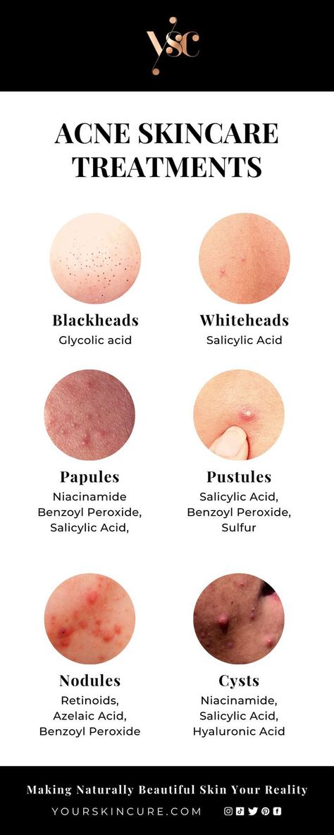 Healthy Skin Tips, Skin Care Remedies, Life Hacks, Healthy Skin Care, Skin Treatments, Healthy Skin Care Acne, Facial Skin Care Routine, Facial Skin Care, Natural Skin Care