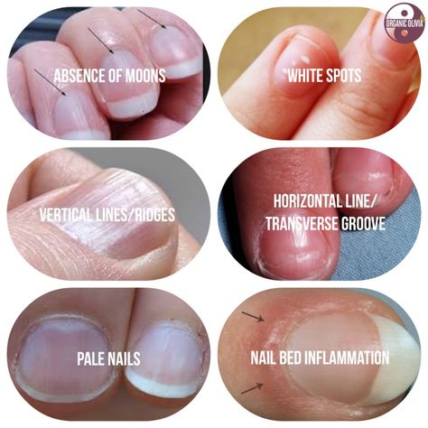 What Your Fingernails are Trying to Tell You About Your Health | Organic Olivia Health Tips, Home Remedies, Health, Nail Health, Fingernail Health, Natural Cures, Remedies, Calendula Benefits, Lemon Benefits