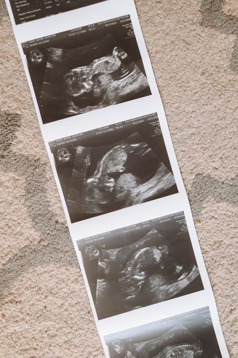 For those of you who haven't already been over to my Instagram to hear the news, press play to find out the gender of Baby Hallak #2! Instagram, 12 Week Ultrasound Pictures, 12 Weeks Pregnant Ultrasound, 16 Weeks Pregnant Ultrasound, 10 Week Ultrasound Pictures, 5 Weeks Pregnant Ultrasound, Baby Ultrasound Pictures, 12 Weeks Pregnant, Pregnant Baby