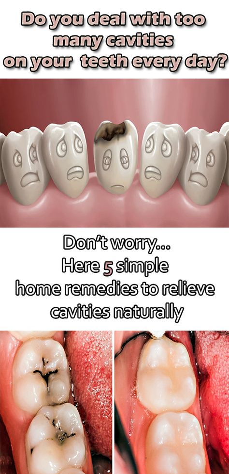 Eating too much sugar or not paying enough attention to teeth cleaning can cause tooth decay and tooth cavity. Due to worms in the teeth, that tooth gradually ends. But by adopting some home remedies, cavities can get rid of naturally. Worms, Tooth Decay Treatment, Tooth Decay Remedies, Cure Tooth Decay, Heal Cavities, Natural Oral Care, Teeth Cleaning, Teeth Health, Tooth Decay