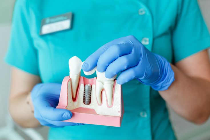 Dental Insurance, Dental Implants Cost, Dental Cleaning, Dental Care, Cheap Dental Implants, Dental Procedures, Dental Implant Surgery, Oral Health