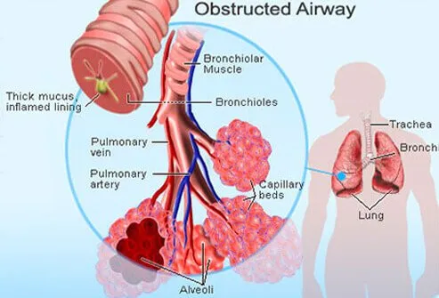 Inflammation is the main cause of airway narrowing during asthma episodes.