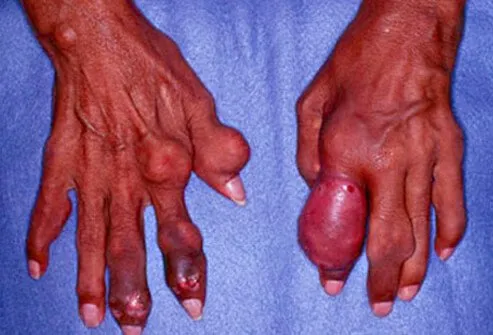 Inflamed lumps of tissue may form in the joint with repeated bouts of gout or in prolonged cases. 