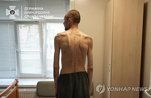 뼈만 남은 앙상한 몸…러시아서 2년만에 돌아온 우크라 포로