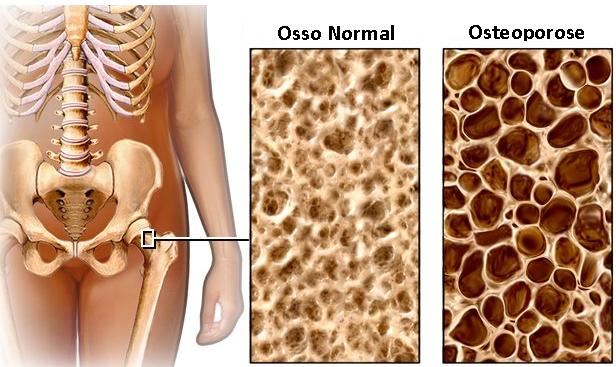 3970017_osteoporose01 (616x367, 52Kb)