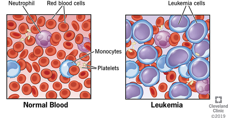 Normal blood consisting of red blood cells, white blood cells and platelets versus blood with leukemia cells.