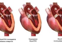 Хирурги хабаровского кардиоцентра первыми в России имплантировали транскатетерный аортальный клапан, чтобы спасти 83-летнюю пациентку. Об этом сообщили в телеграм-канале центра. 
