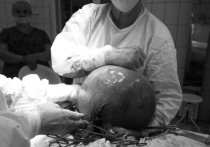 В Бийске врачи удалили из брюшной полости пациентки огромное новообразование размером с футбольный мяч