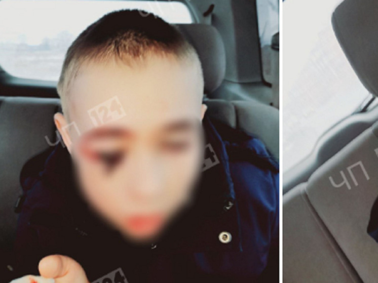 В Канском районе собака напала на 10-летнего мальчика и повредила ему глаз