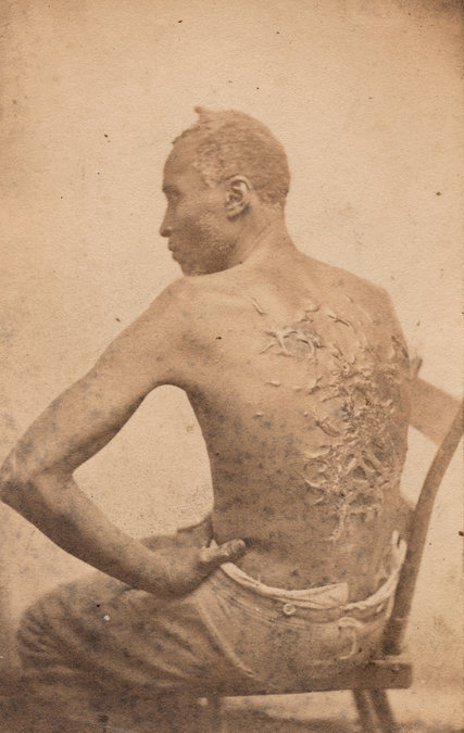 "Gordon, a Runaway Mississippi Slave, or 'The Scourged Back,'" 1863, attributed to McPherson & Oliver.